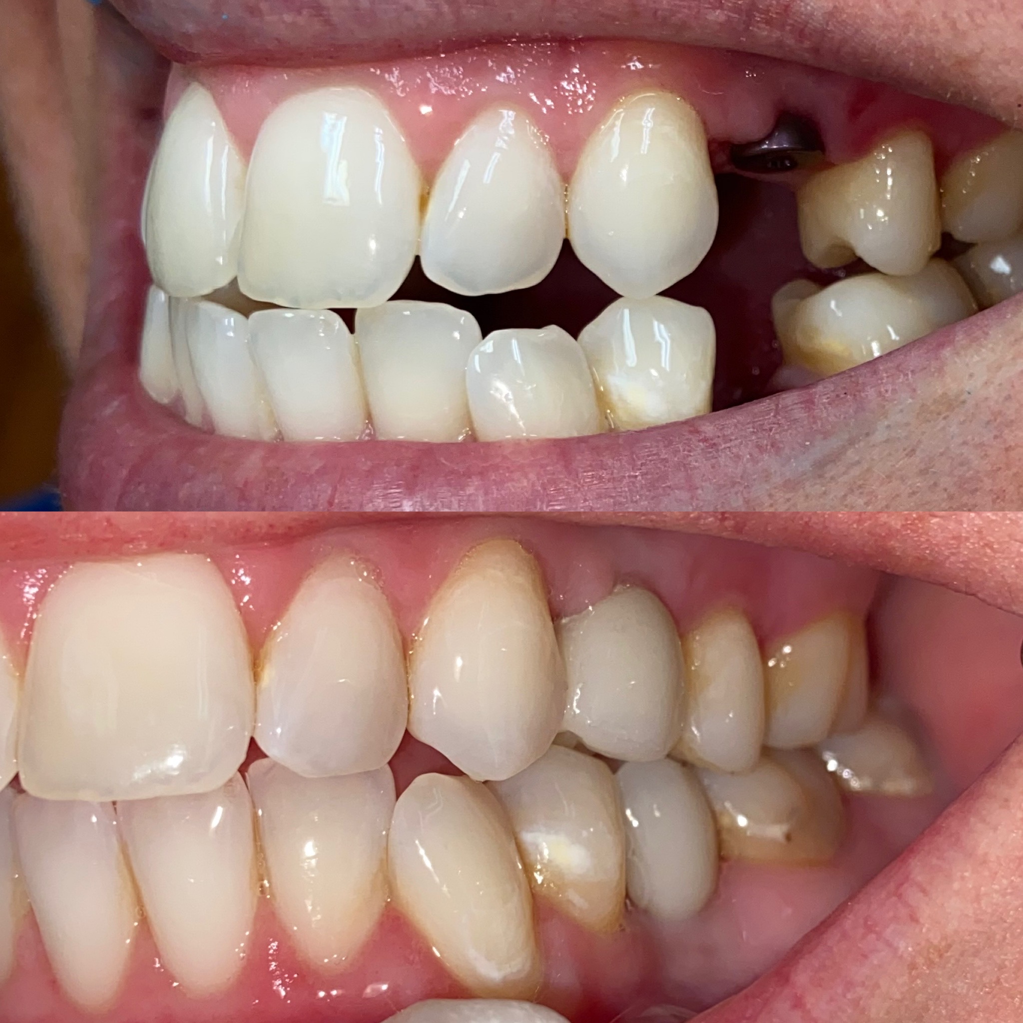 Yellowed and damaged front teeth