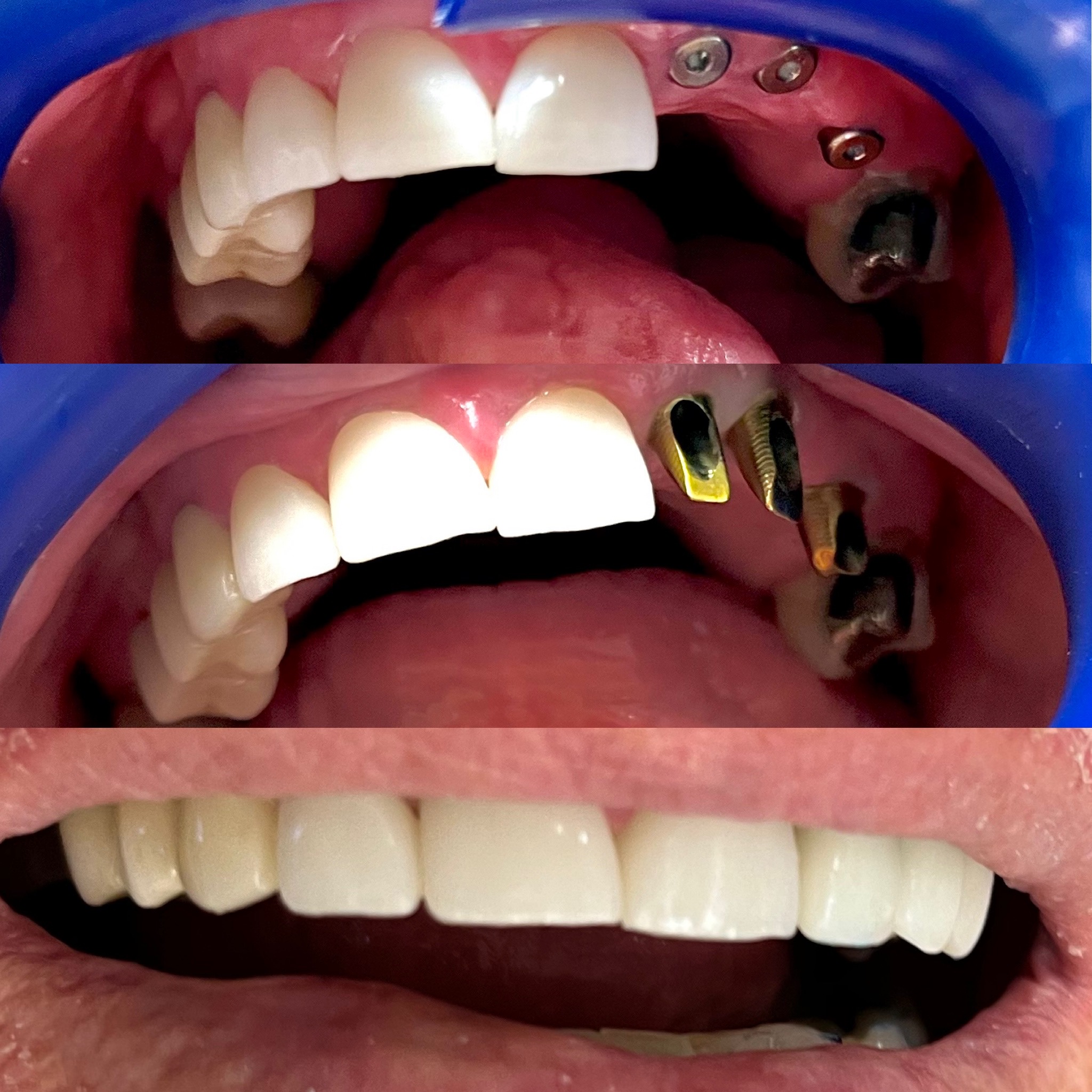 Yellowed and damaged front teeth