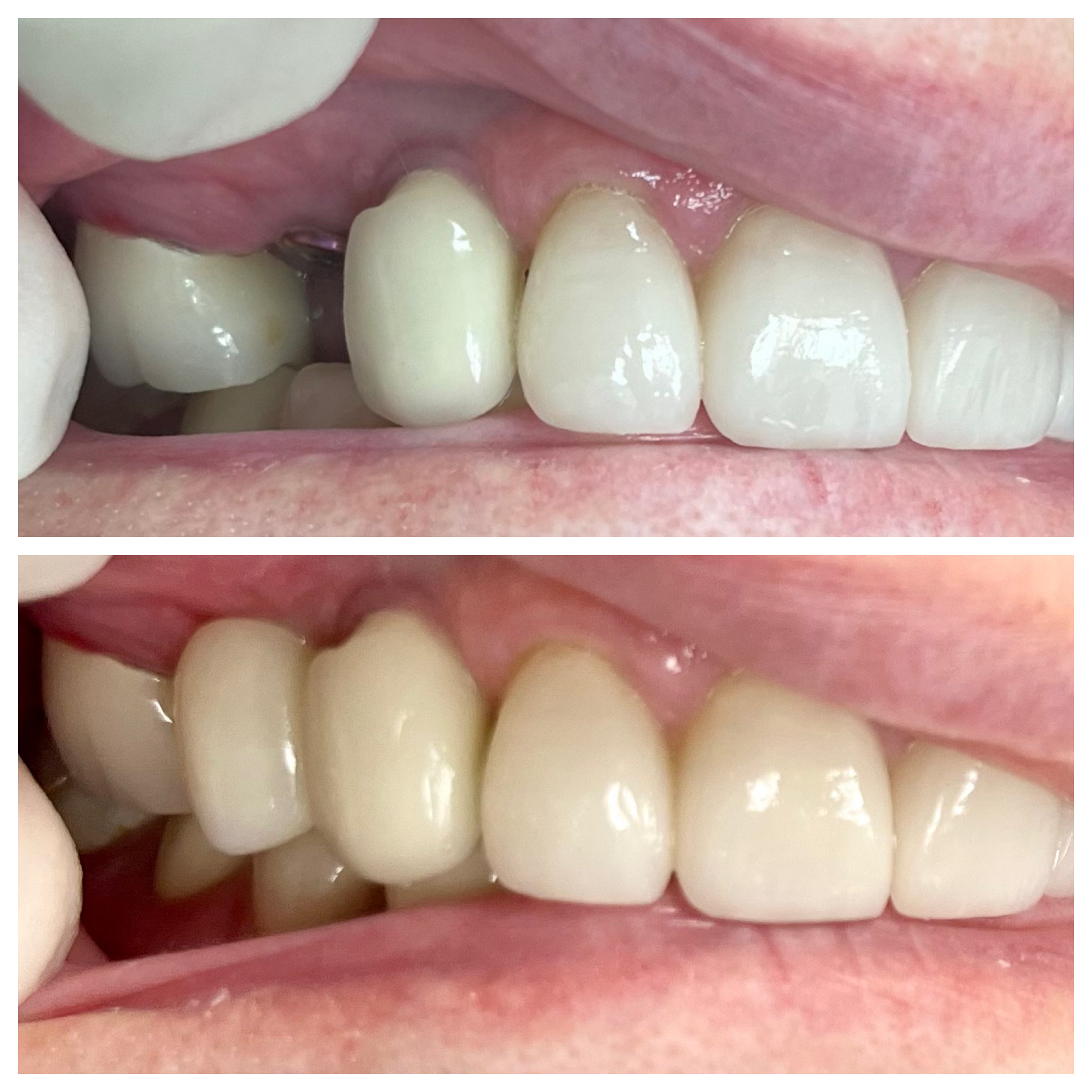 Yellowed and damaged front teeth