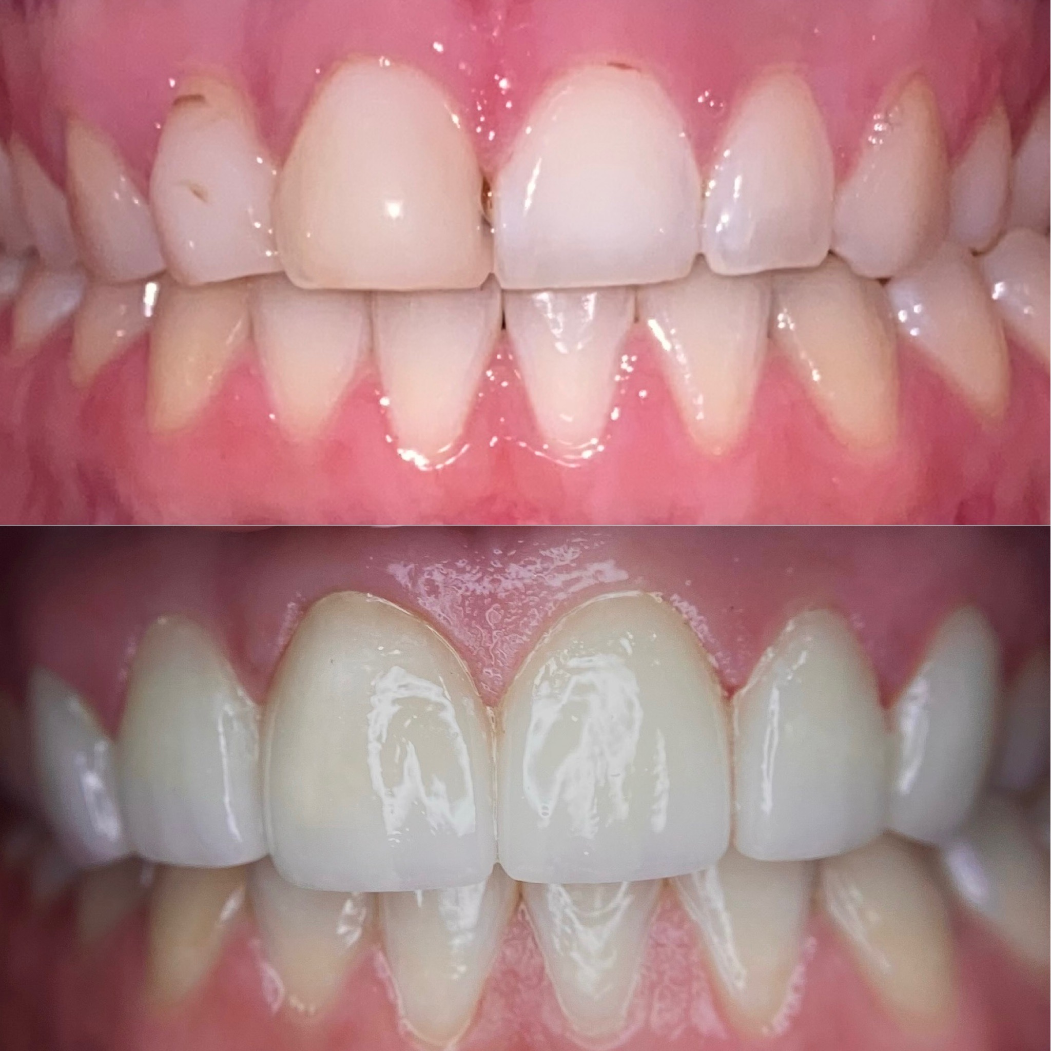 Yellowed and damaged front teeth