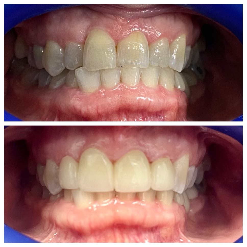 Yellowed and damaged front teeth