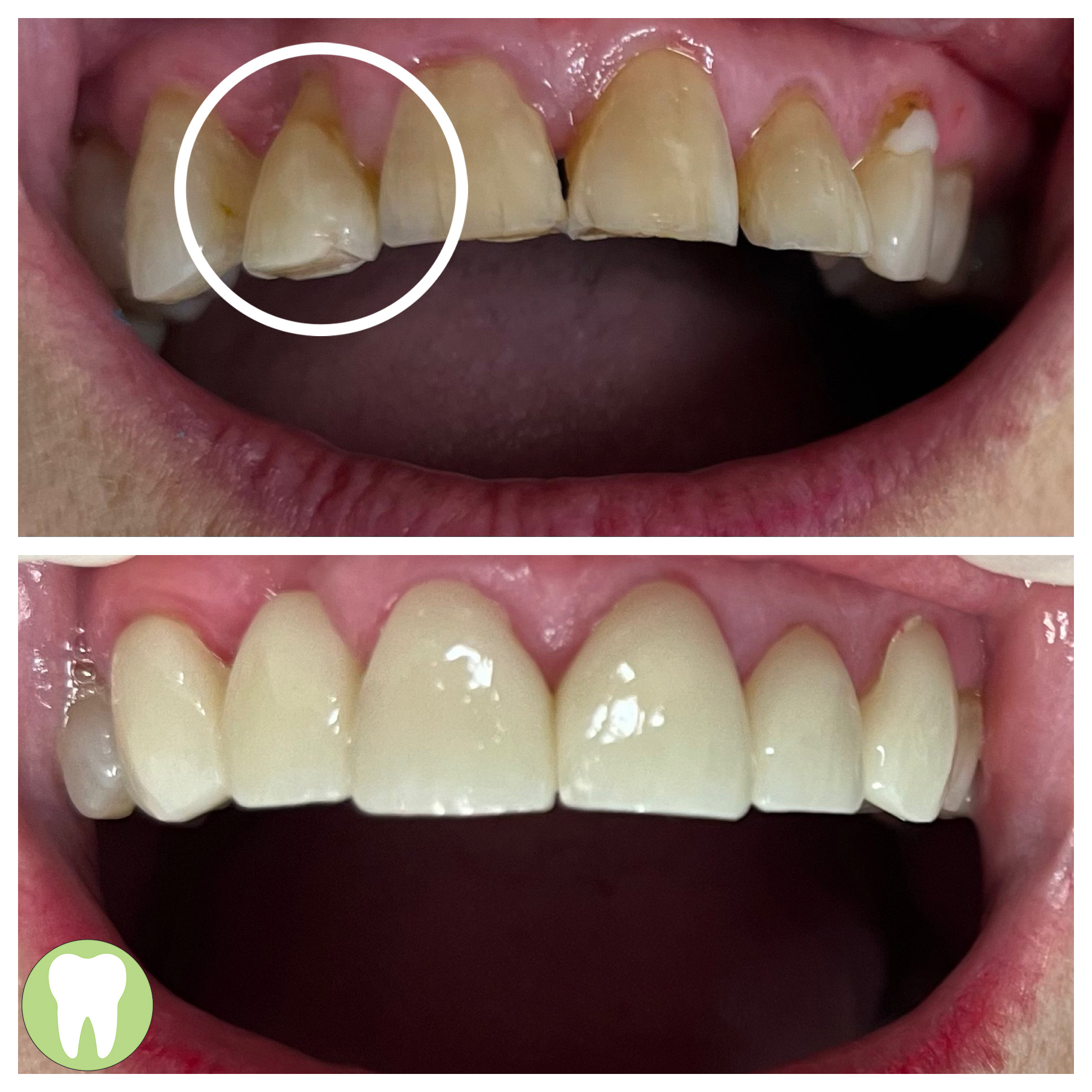 Yellowed and damaged front teeth