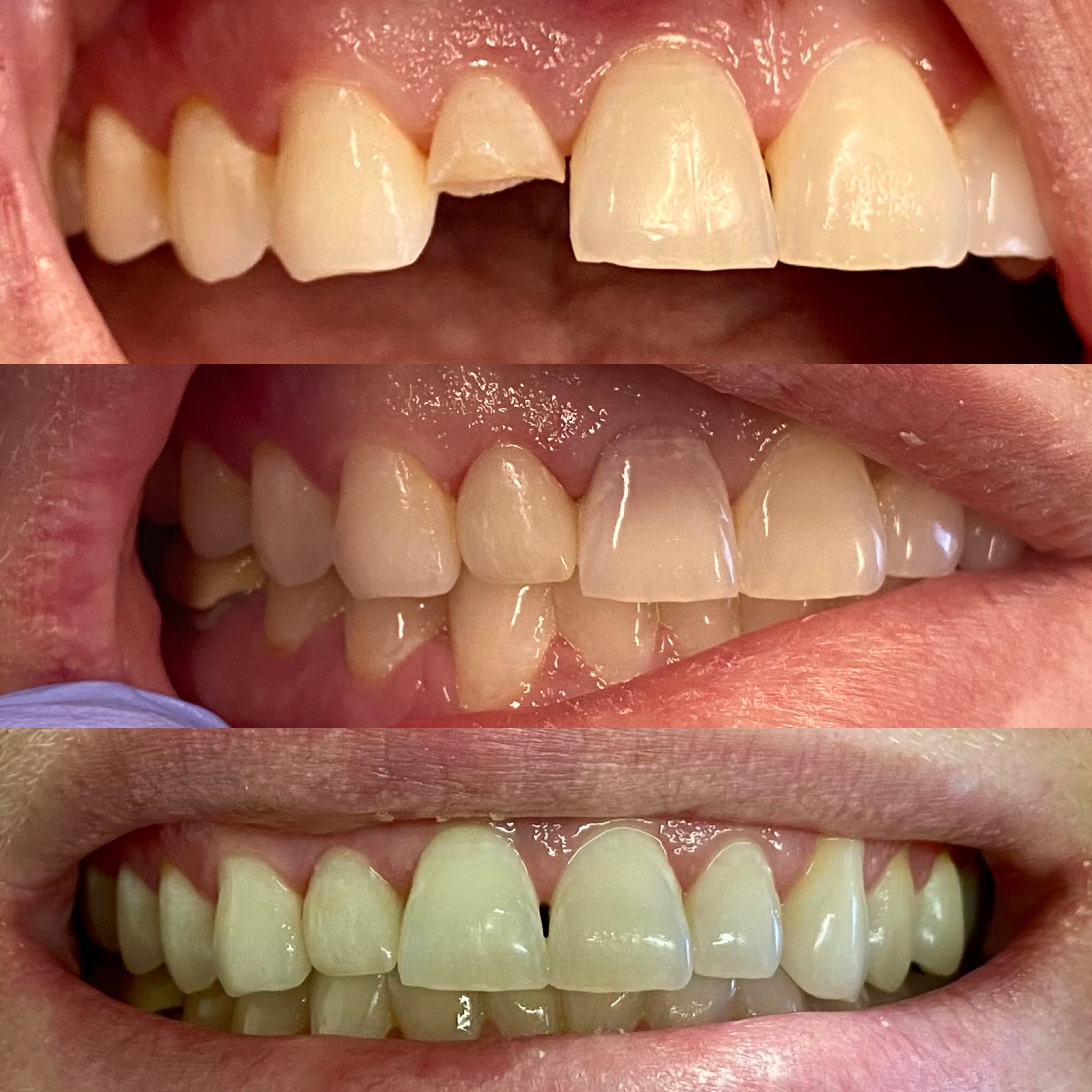 Yellowed and damaged front teeth