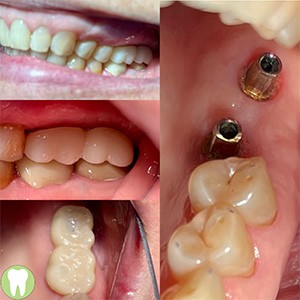 Yellowed and damaged front teeth