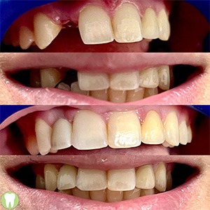 Yellowed and damaged front teeth