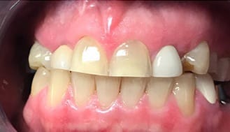 Severely worn teeth