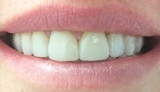 Healthy beautiful smile after treatment