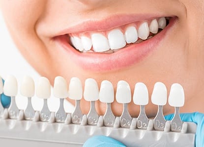 Smile compared with tooth shade chart