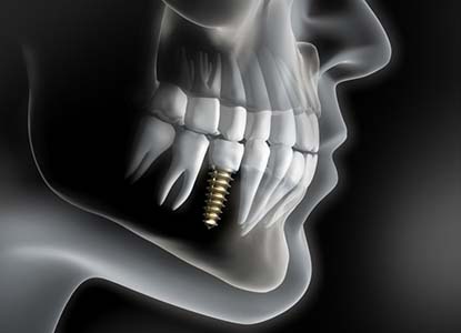 X-ray of a patient with a dental implant